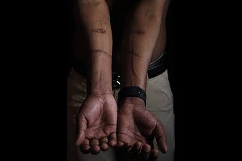 Sri Lankan man known as Witness #205 shows scars on his arms during an interview in London
