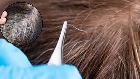 Think Before You Pluck That White Hair: What You Need to Know About Premature Graying