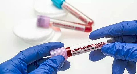 COVID-19: Swab samples of media persons test negative in Tinsukia