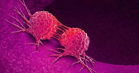 Cancer patients in Assam discontinue treatment due to COVID-19 outbreak