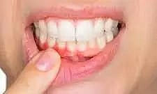 Suffering from bleeding gums? Here are some home remedies