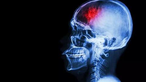Century of data show COVID-19 likely to impact the brain
