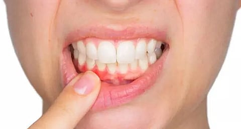 Bleeding gums may indicate vitamin C deficiency: Study