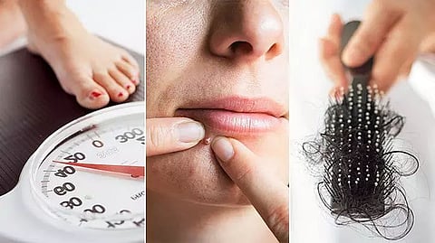 PCOS and its effects on skin and hair