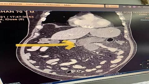 Black fungus of intestine Novel complication diagnosed in COVID patients in Delhi