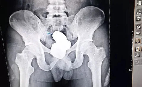 Man Hides Gold Paste Worth ₹ 42 Lakh In Rectum, Caught At Imphal Airport