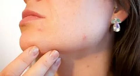 Nearly 1 in 2 people in Europe have skin problem: Study