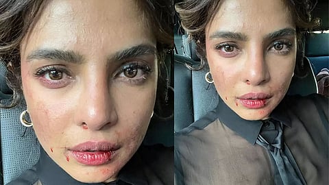 Priyanka Chopra shares picture of 'bruised' face