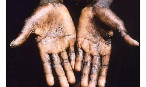 Monkeypox Virus: Centre Raises Alarm Bells, Orders Surveillance At All International Entry Points