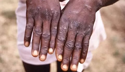 Monkeypox doesn't spread easily by air like Covid: US