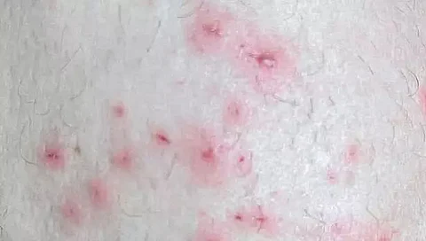 Monkeypox spreads through sustained face-to-face contact: CDC