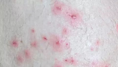 Suspected case of monkeypox found in Nepal