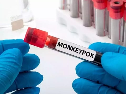 95% monkeypox spread occurred via sexual activity'