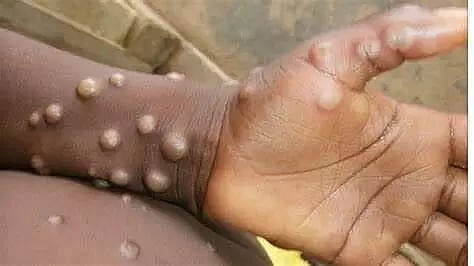 Third monkeypox case registered in Kerala