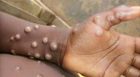 Centre forms task force to monitor monkeypox cases