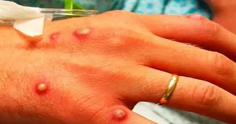 State of emergency in California due to monkeypox outbreak