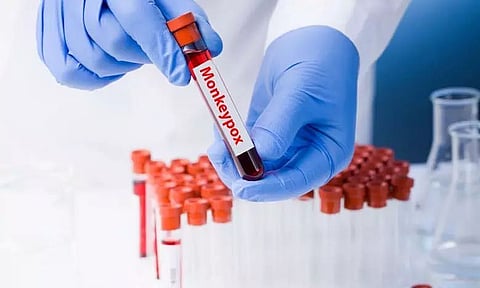 Ring vaccination may not be effective against monkeypox