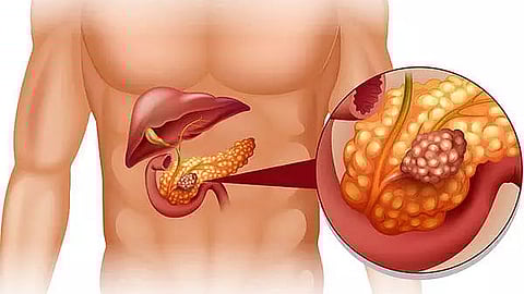 Acute Pancreatitis: Causes, Symptoms, Complications, and Treatments