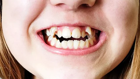 Dental Matters: Understanding Malocclusion and Misaligned Teeth