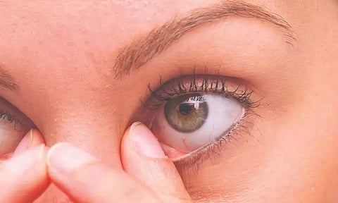 Pratishruti Foundation organized free eye screening camp in Sonapur