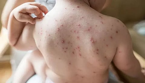 Three die of chicken pox at Behali under Biswanath sub division