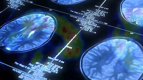 Eli Lilly’s Alzheimer's drug shows promise to slow disease