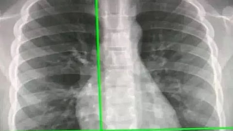 Artificial Intelligence-powered X-rays can tell true age by looking at chest