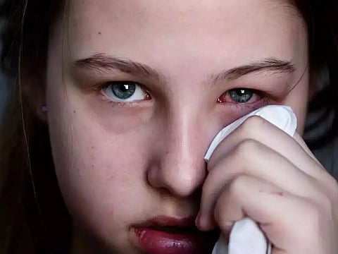 Health advisory issued as number of conjunctivitis cases being reported across the district