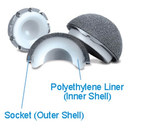 Custom Joint replacements