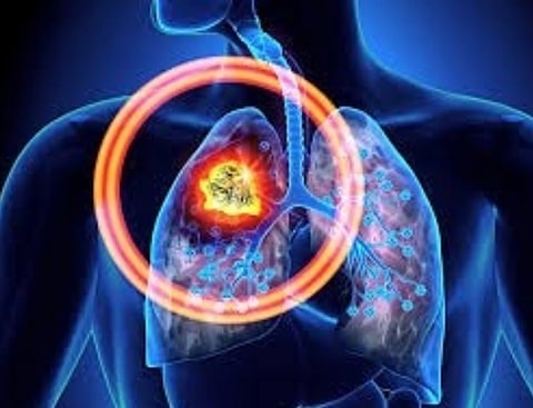 Lung Cancer: Blame Toxic Air as Well