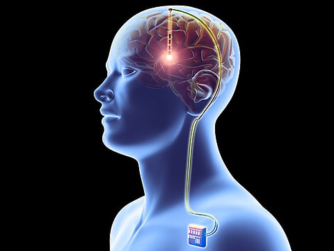Researchers developed Brain pacemaker to treat epilepsy, Parkinson’s