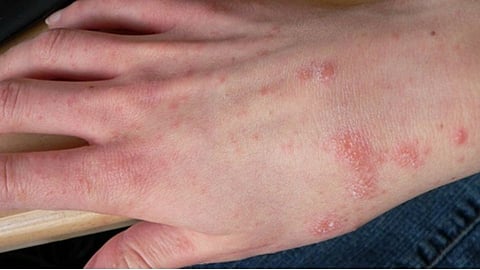 Expert Tips: किचनमधिल या 5 गोष्टीचा वापर करून खाज सुटण्यापासून मुक्ती मिळवा