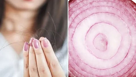 घरी बनवा Onion Gel जे दूर करेल केसांचा पातळपणा