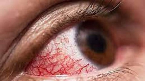 कोरोना रुग्णांनो, म्युकरमायकोसीसला घाबरू नका; मधुमेह नियंत्रित ठेवा