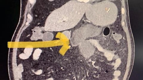 बापरे! आतड्यांच्या दुर्मिळ ब्लॅक फंगसचे दोन नवे रुग्ण