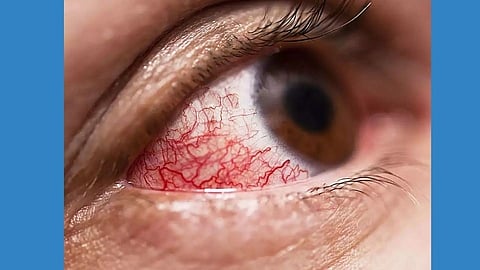 सांगलीत म्युकर मायकोसिसची एंट्री; तज्ज्ञांनी दिला सल्ला