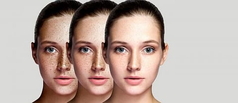 या पाच चुकांमुळे होतो पिगमेंटेशनचा त्रास