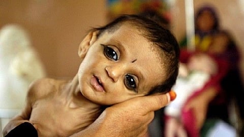 कुपोषित बालकांचा शोध घेण्यासाठी विशेष मोहीम