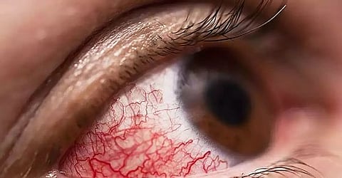 म्युकोरमायकॉसिसच्या उपाचारासाठी उपाययोजना करा