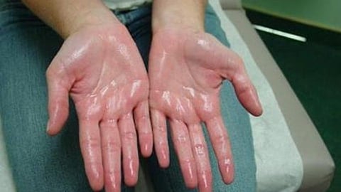 हातला घाम येतोय? या टिप्स करा ट्राय