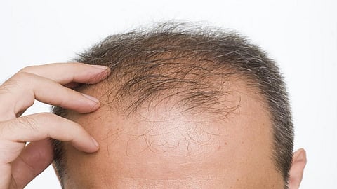 hair loss after corona recovery
