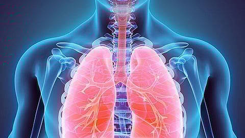 Tuberculosis