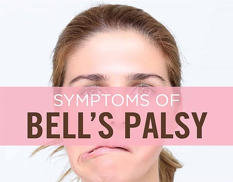 bells palsy decease
