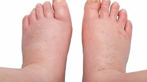 elephantiasis