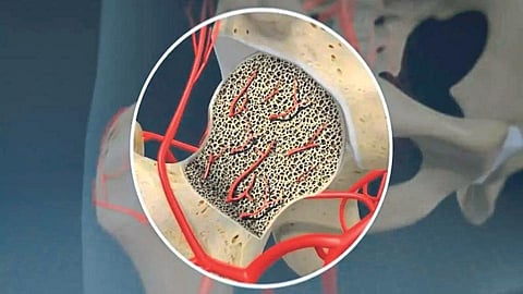 "कोरोनातून बरे झालेल्या रुग्णांना आता बोन-डेथचा धोका!'