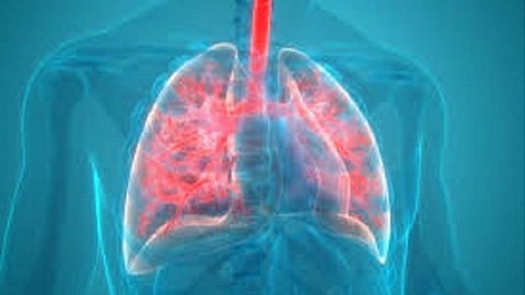 pneumonia