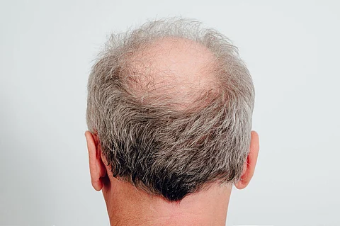 Bald
