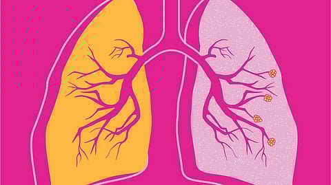 तंबाखूचे सेवन, चुलीवरील स्वयंपाकामुळे COPD चा धोका वाढला