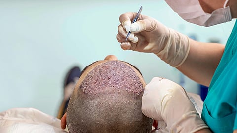 Hair transplant