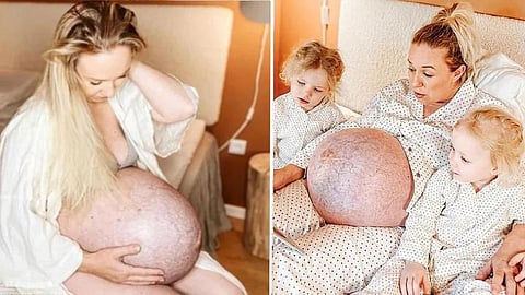 Pregnant Woman shows Unique Baby Bump